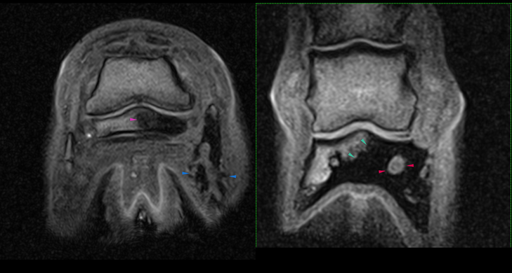 MRI1 arrows