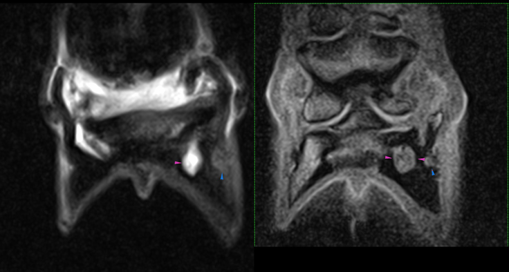 MRI2 arrows