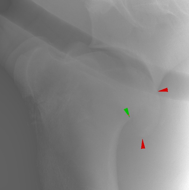 L_SHOULDER_LM arrows